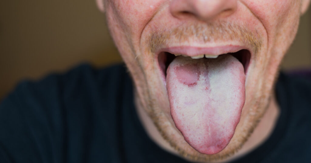 man with tongue disease, has a wound, close-up photo on face
