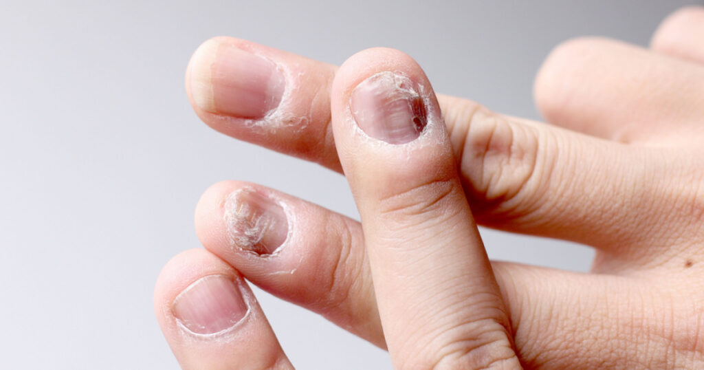 Fungus Infection on Nails Hand, Finger with onychomycosis. - soft focus
