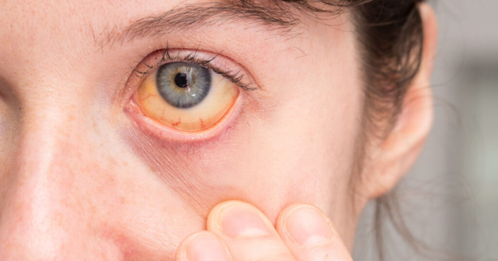 Close-up of girl's eye with yellow sclera caused by jaundice

