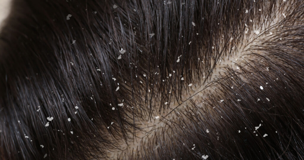 Woman with dandruff in her dark hair, closeup view
