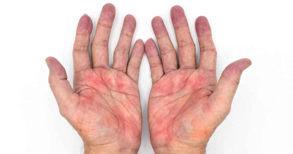Palmar erythema often called liver palms in both hands of Southeast Asian, Myanmar man. Isolated on white background.
