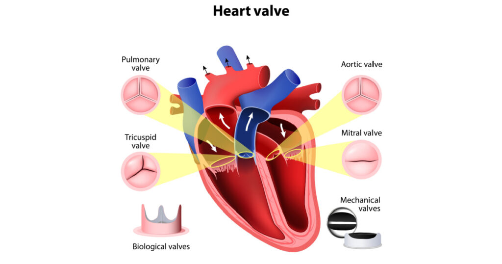 Heart valve surgery. Pulmonary, Tricuspid, Aortic and Mitral valve. Biological valves and Mechanical valves

