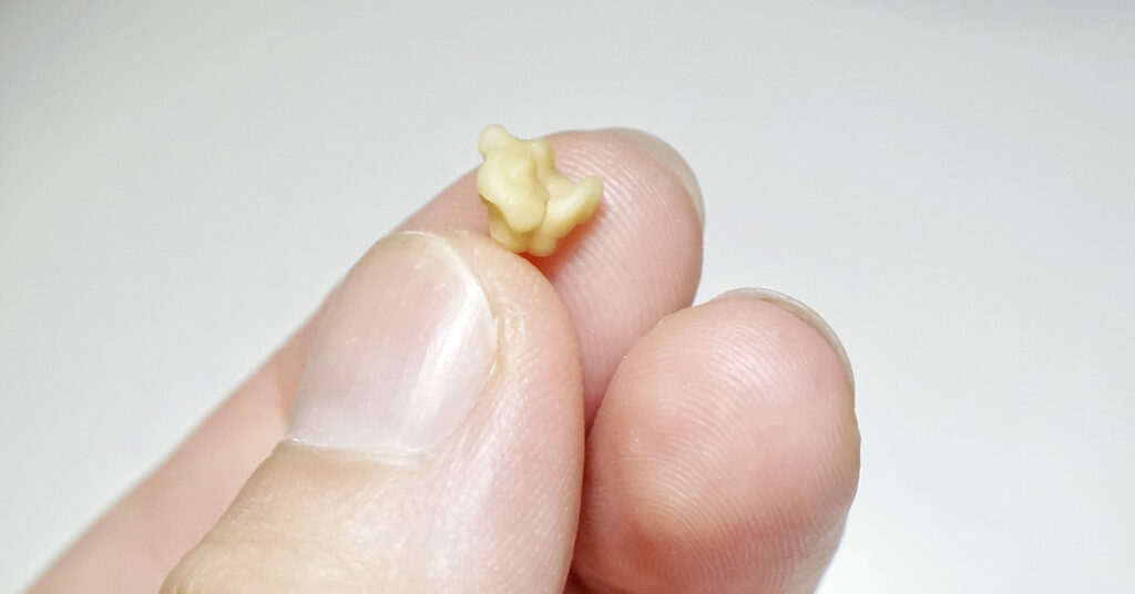 Here’s What You Need to Know About Tonsil Stones - Featured image