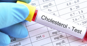 How to Help Lower Cholesterol Without Medication test tube labelled Cholesterol