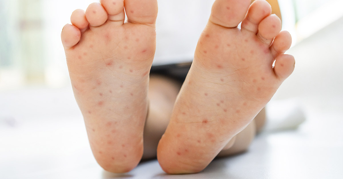 spots on bottom of feet. Hand-foot-and-mouth disease concept