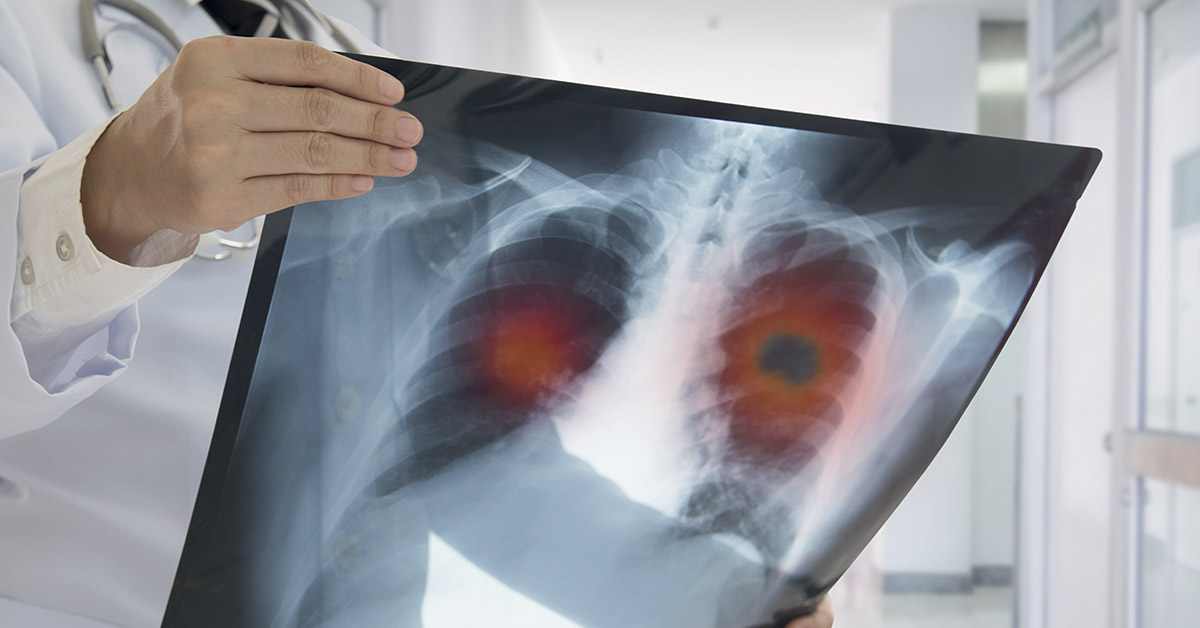 doctor holding xray of lungs with red highlights. Lung cancer concept