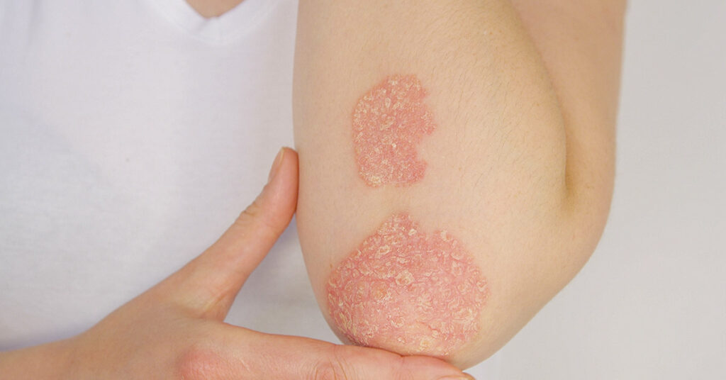 10 Ways to Help Beat Psoriasis Naturally - Featured image