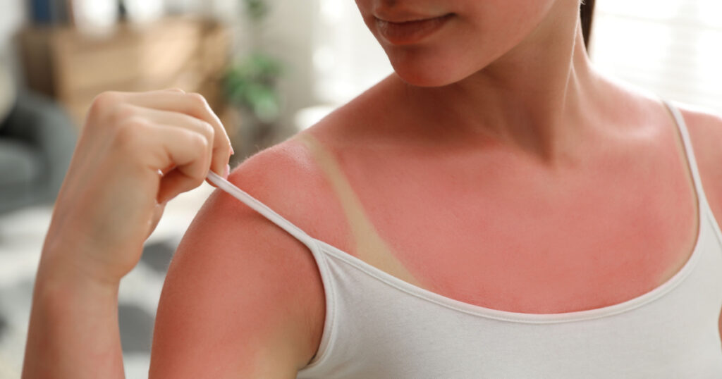 Woman with sunburned skin at home, closeup
