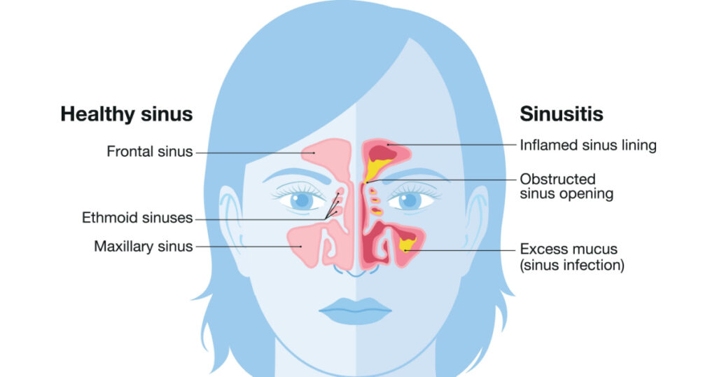 Vector illustration showing healthy sinus and sinusitis with inflamed lining, obstructed sinus opening, adenoid and excess mucus
