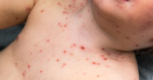 Mom's Facebook Post Serves as a Reminder Why You Shouldn't Treat Chickenpox with Ibuprofen Shutterstock_687158989