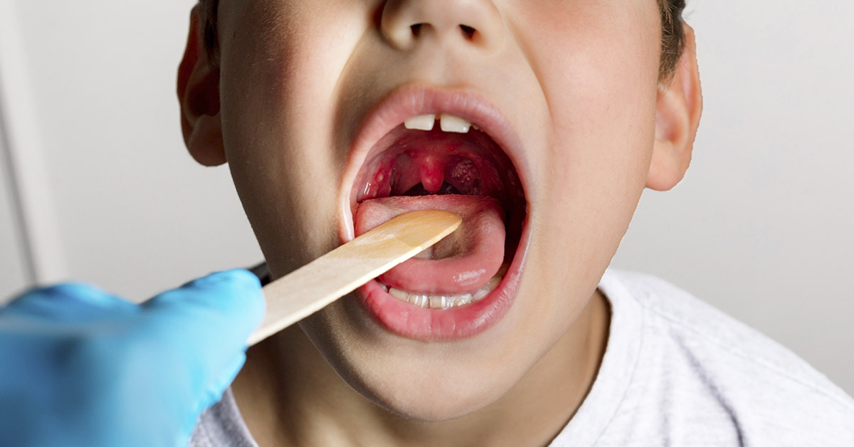 child's mouth open as doctor examines oral cavity using a tongue depressor