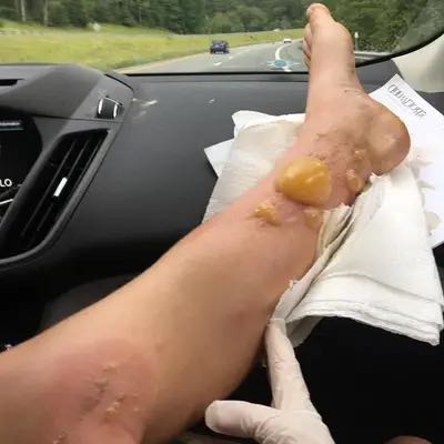 Charlotte Murphy chemical burns on leg from Wild Parsnip 