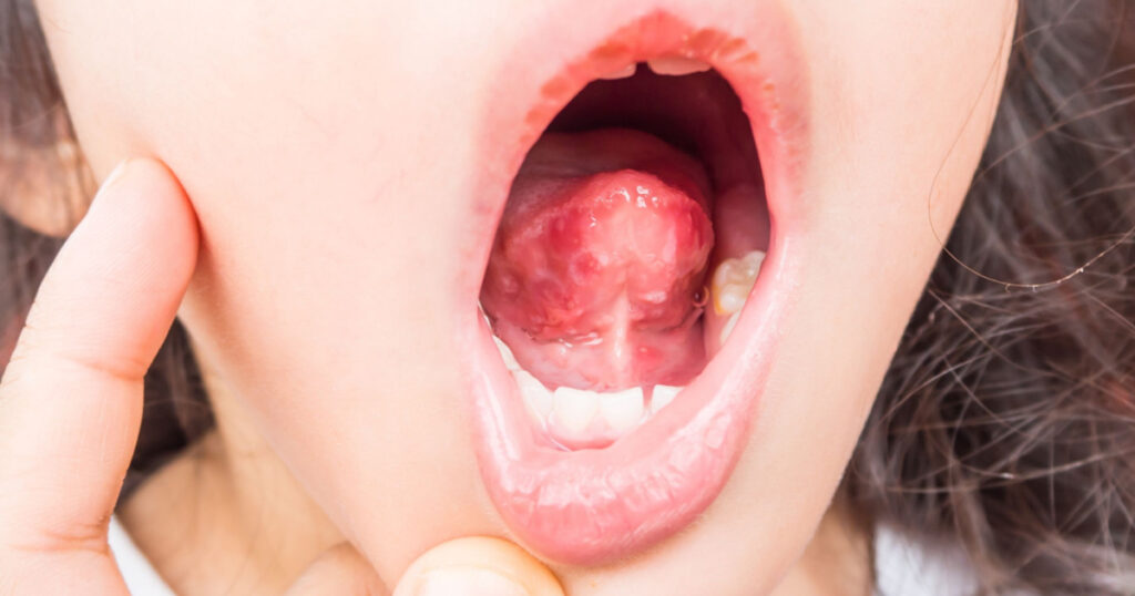 Red and white spot under tongue.Child infected with virus.Herpangina disease,Hand foot and mouth disease, HFMD

