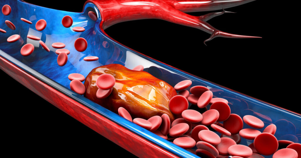 3d Illustration of Deep Vein Thrombosis or Blood Clots. Embolism.
