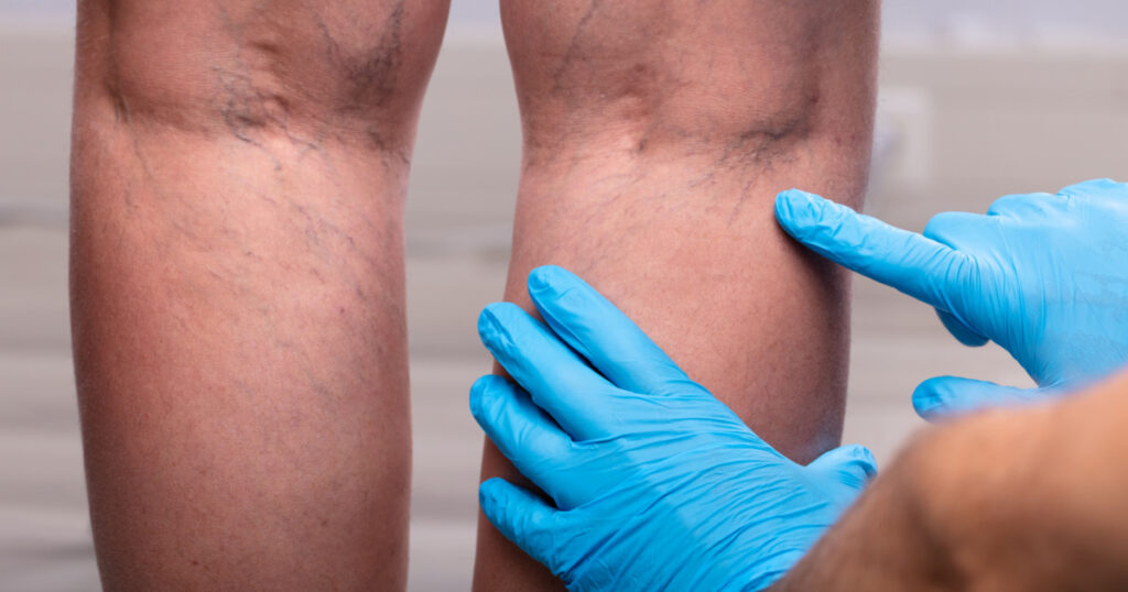 Medic With Blue Latex Surgical Gloves Touching Varicose Veins On Patient's Leg
