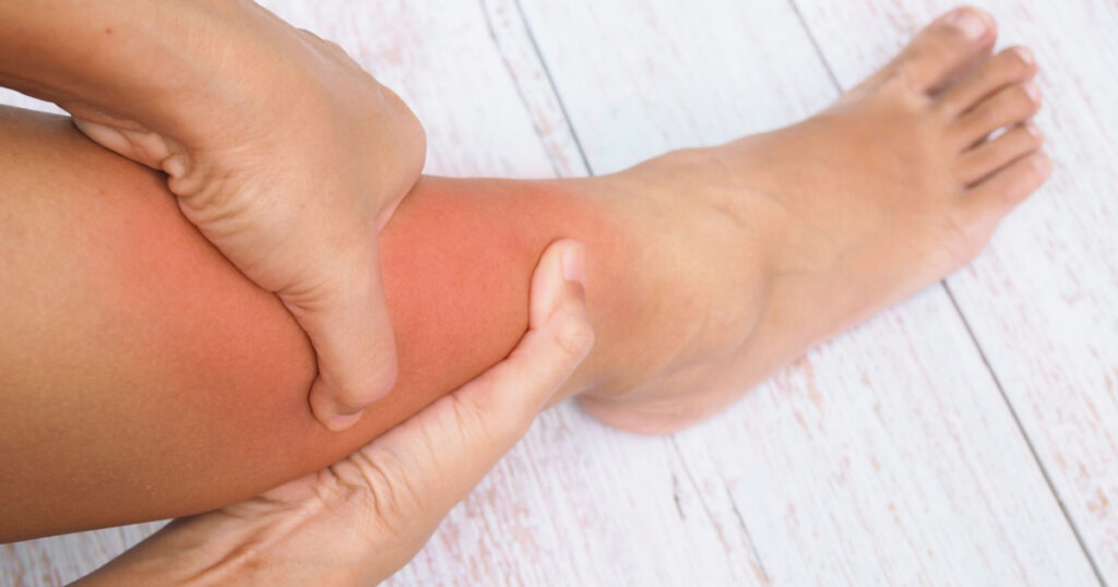 Women suffering with leg pain, ankle pain, inflammation and red swelling.
