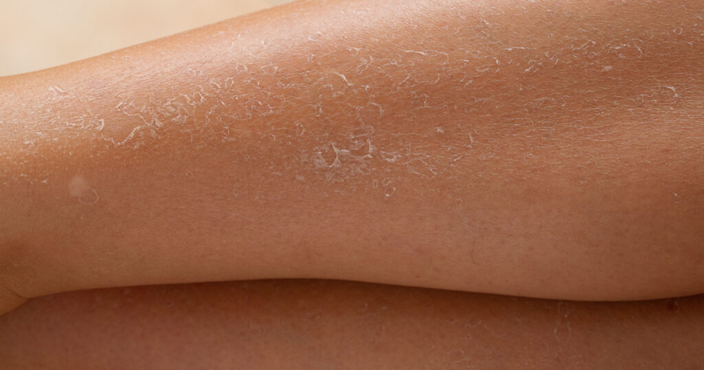 Detail of dry skin of woman legs. Dehydration due to the sun's rays without sun protection cream