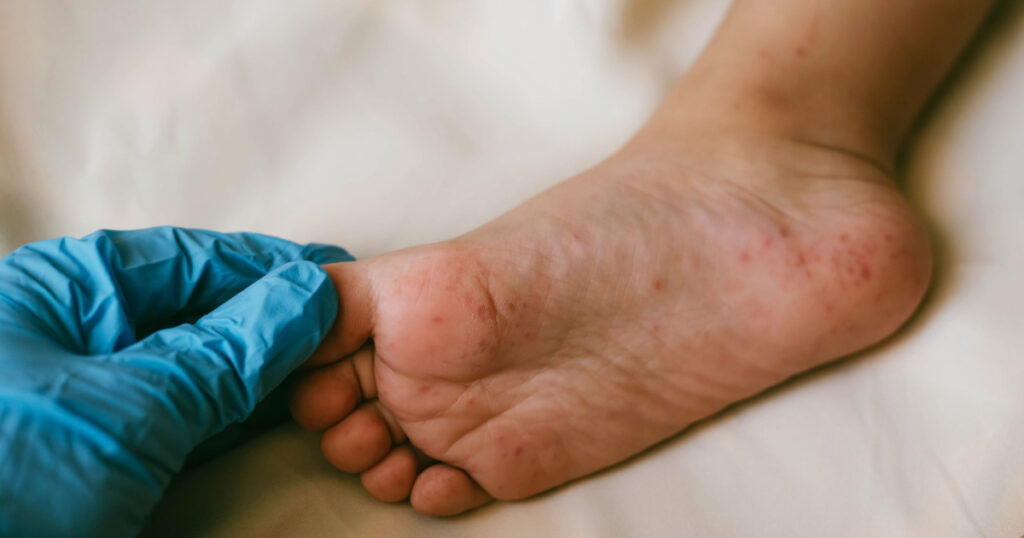 Rash of enterovirus infection picornavirus families on the feet of a 3-year-old child. Medicine, health concept
