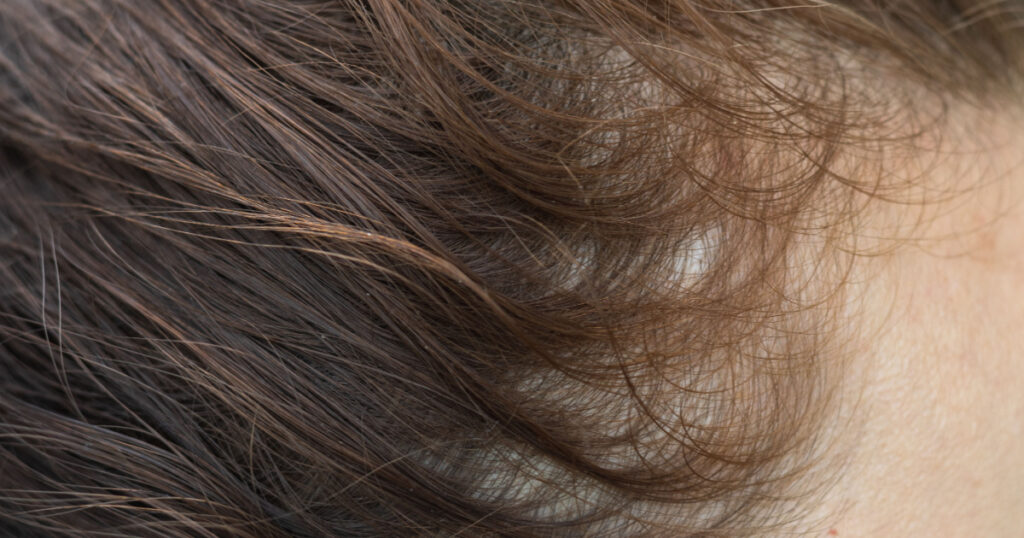 Female hair loss. Close-up photography of female head with weak and thinning hair, the baldness in women.
