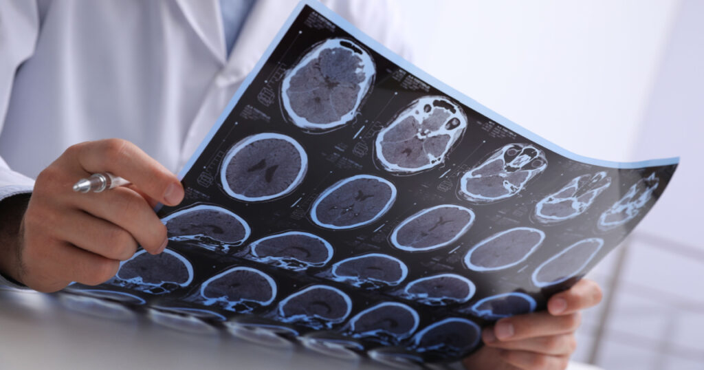 Doctor examining MRI images of patient with multiple sclerosis at table in clinic, closeup
