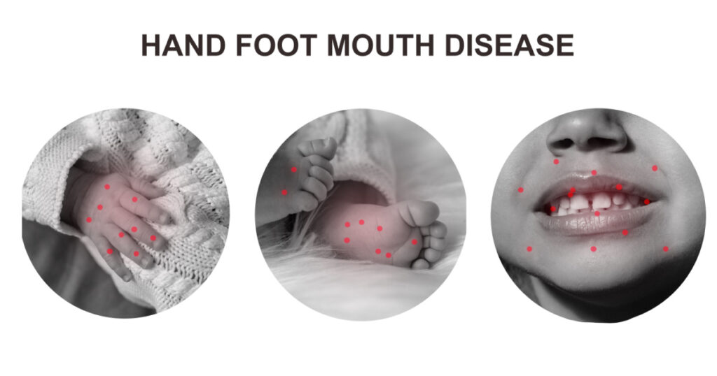 A bunch of hand foot mouth disease. Set of baby body details in circles isolated on white background. modern line art collage
