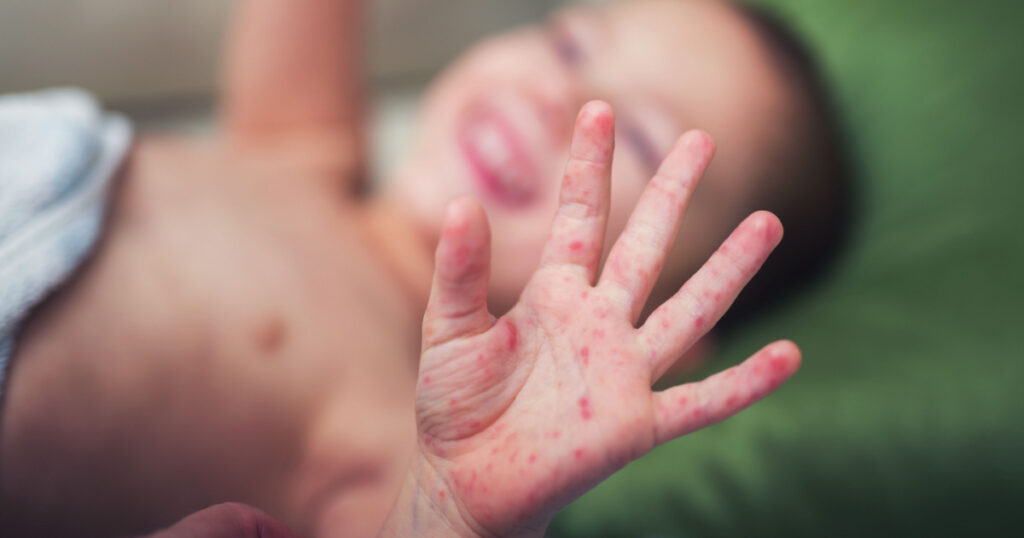 Boy with symptoms hand, foot and mouth disease
