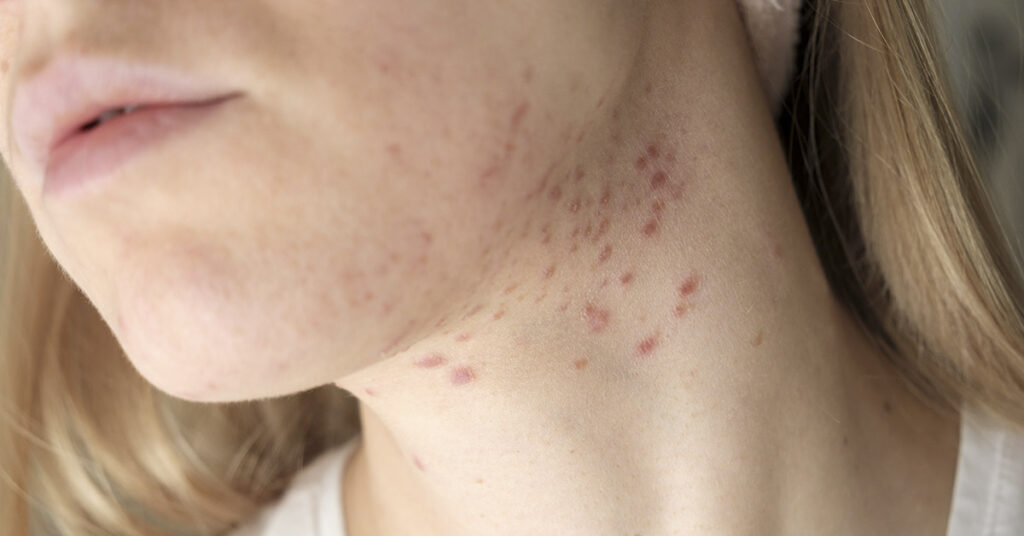 woman with rash on neck