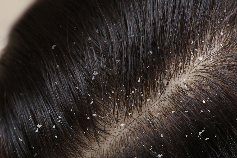 Woman with dandruff in her dark hair, closeup view
