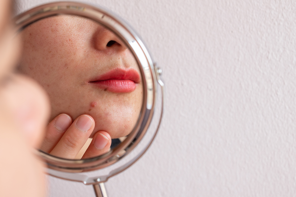 Cropped shot of woman worry about her face when she saw the problem of acne occur on her chin by a mini mirror. Conceptual shot of Acne and problem skin on female face.
