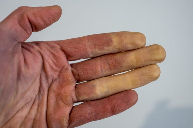 Rare Toes Rare Disorder Can Turn Fingers, Toes White or Blue When it's Cold