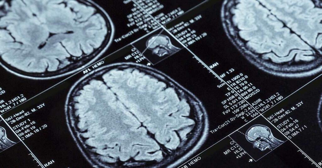 Death of Teen Attributed to Tapeworm Eggs Found in His Brain from Eating Undercooked Pork - Featured image