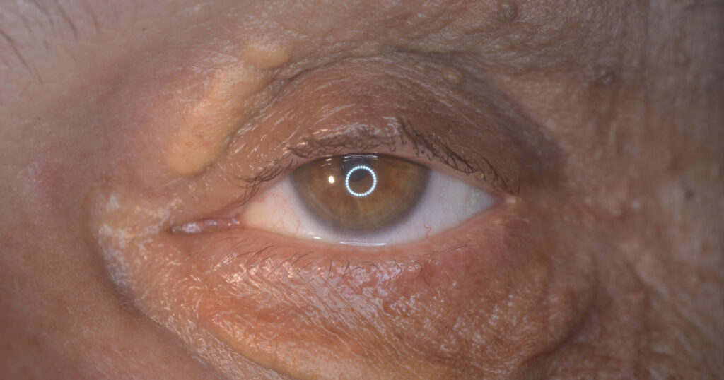 close up of the xanthelasma during eye examination.
