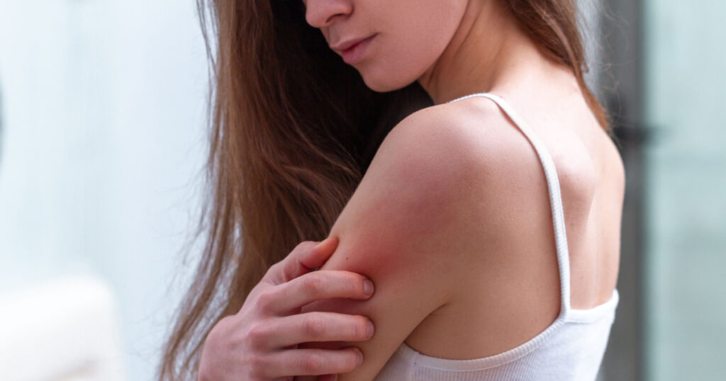Young woman suffering from itching on her skin and scratching an itchy place. Allergic reaction to insect bites, dermatitis, food, drugs. Health care concept. Allergy rash