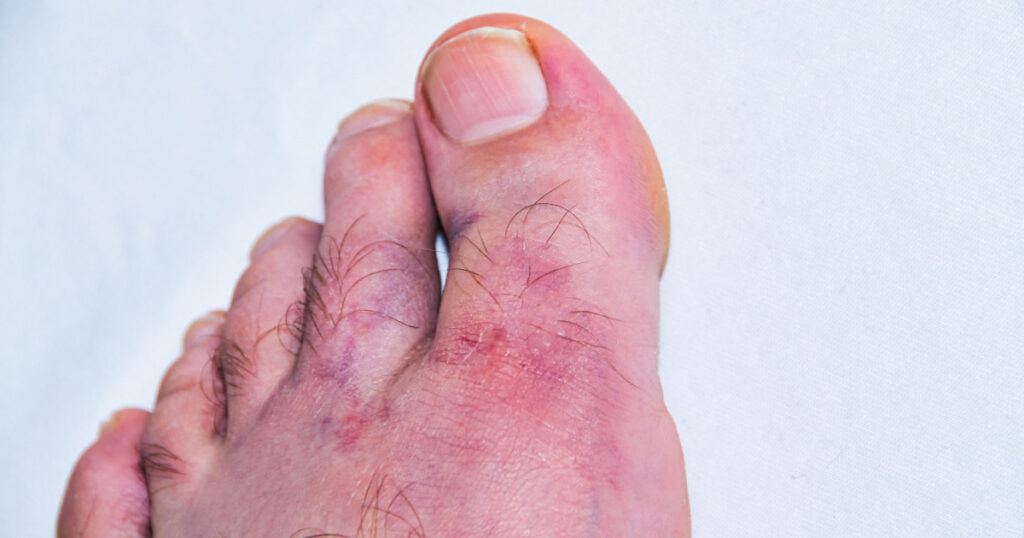 Severe contusion of a caucasian male foot from a work accident