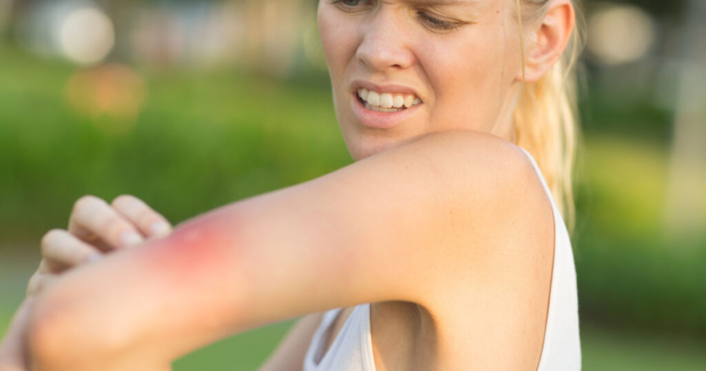 Itchy insect bite - Irritated young female scratching her itching arm from a mosquito bite at the park during summertime.
