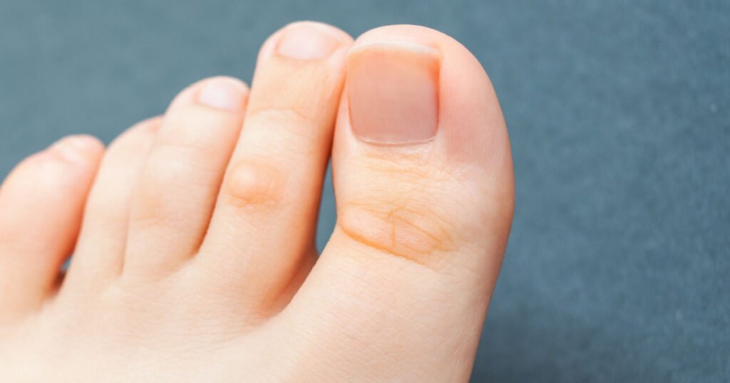 A young woman has hard corns on her toes from wearing shoes that don’t fit properly and uncomfortable. Female foot. Closeup view.