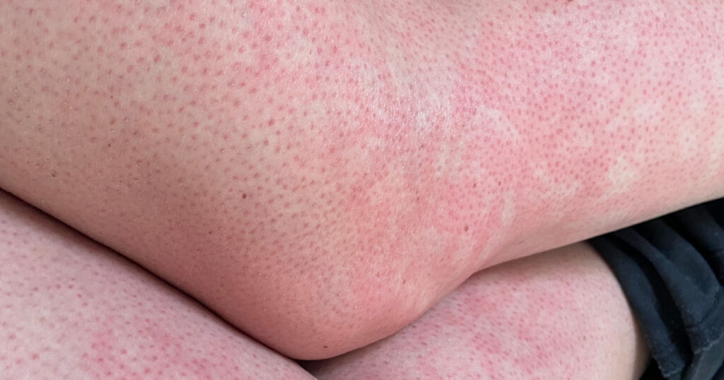 mottled skin heat rash hives allergy reaction on knee close-up reference picture of blotchy mottled red skin erythema ab igne also known as EAI this can also happen at end of life death situations