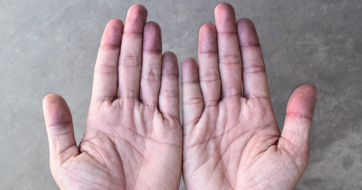 Heart Disease 10 Warning Signs that Appear On Your Skin The Hearty Soul