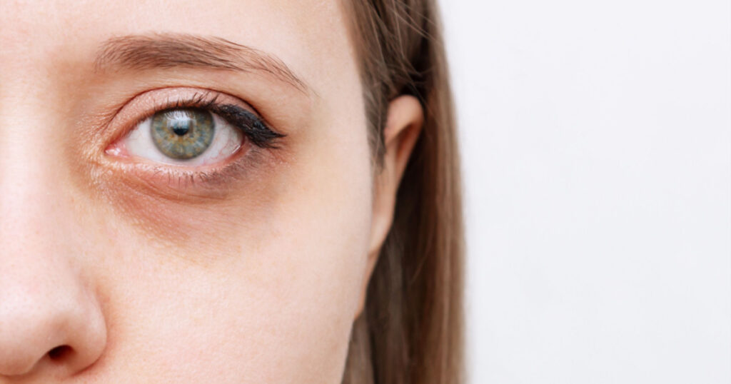 Cropped shot of a young caucasian woman's face with dark circle under eye isolated on a white background. Pale skin, bruises under the eyes are caused by fatigue, lack of sleep, insomnia and stress