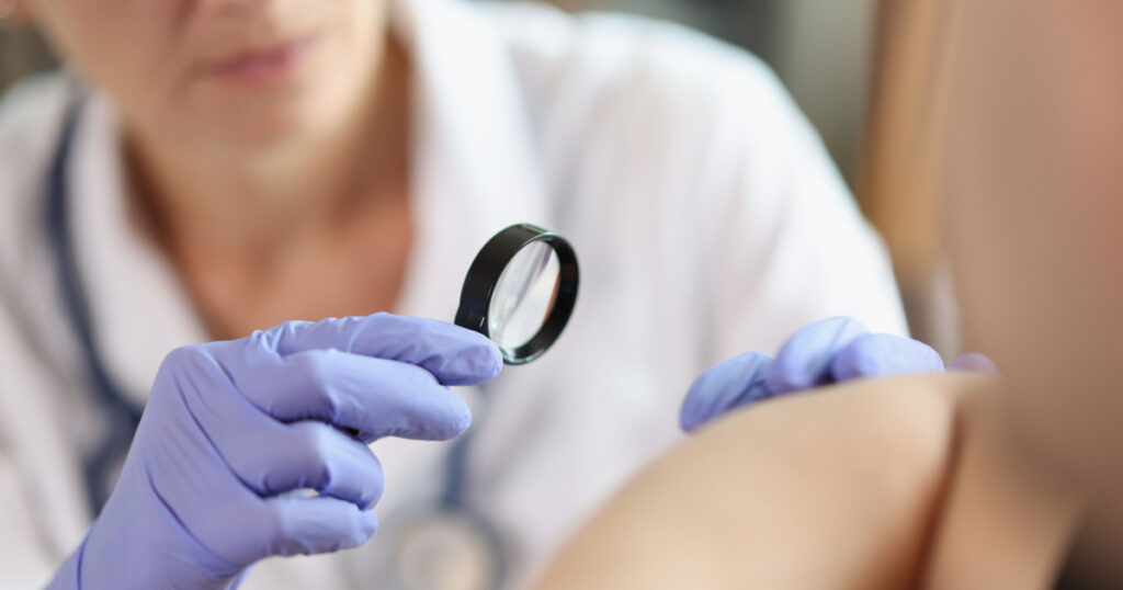 Dermatologist with gloves and magnifying glass examines patient skin in clinic closeup. Doctor checkups derma condition at appointment
