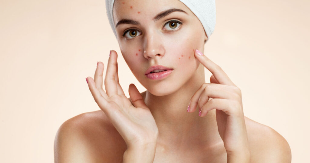 Scowling girl pointing at her acne with a towel on her head. Woman skin care concept / photos of ugly problem skin girl on beige background