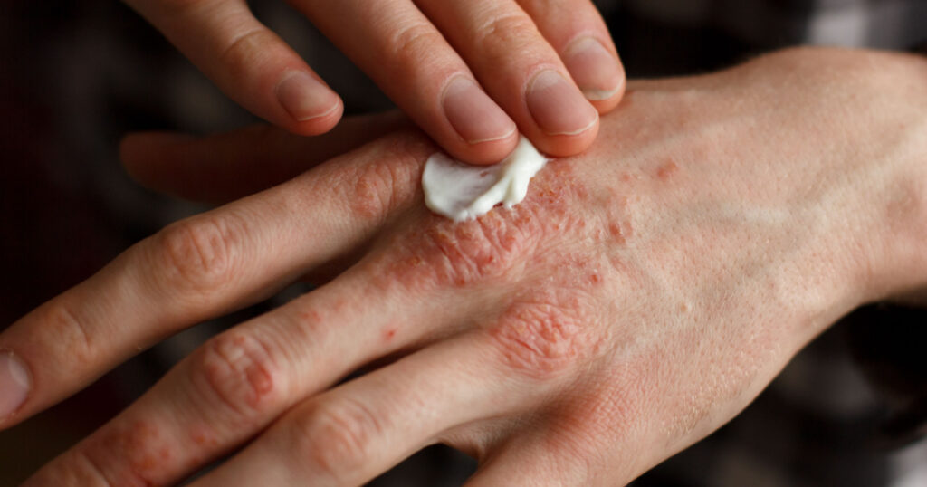 applying an emollient to dry flaky skin as in the treatment of psoriasis, eczema and other dry skin conditions