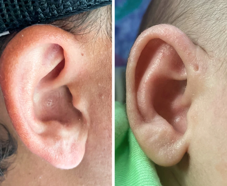 Officially known as the preauricular sinus, this feature manifests as a nodule, dent, or dimple and is a rare characteristic of the human body.