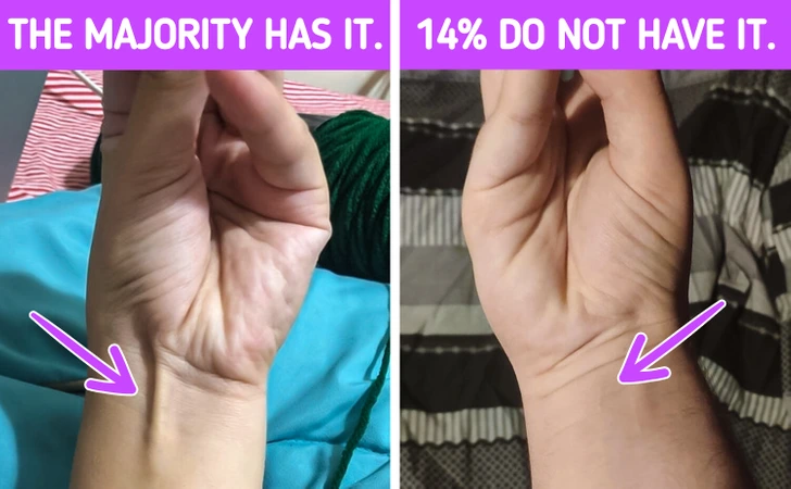 To determine whether one has the palmaris longus tendon, a simple test involves pressing the thumb and the little finger against each other and observing the wrist.