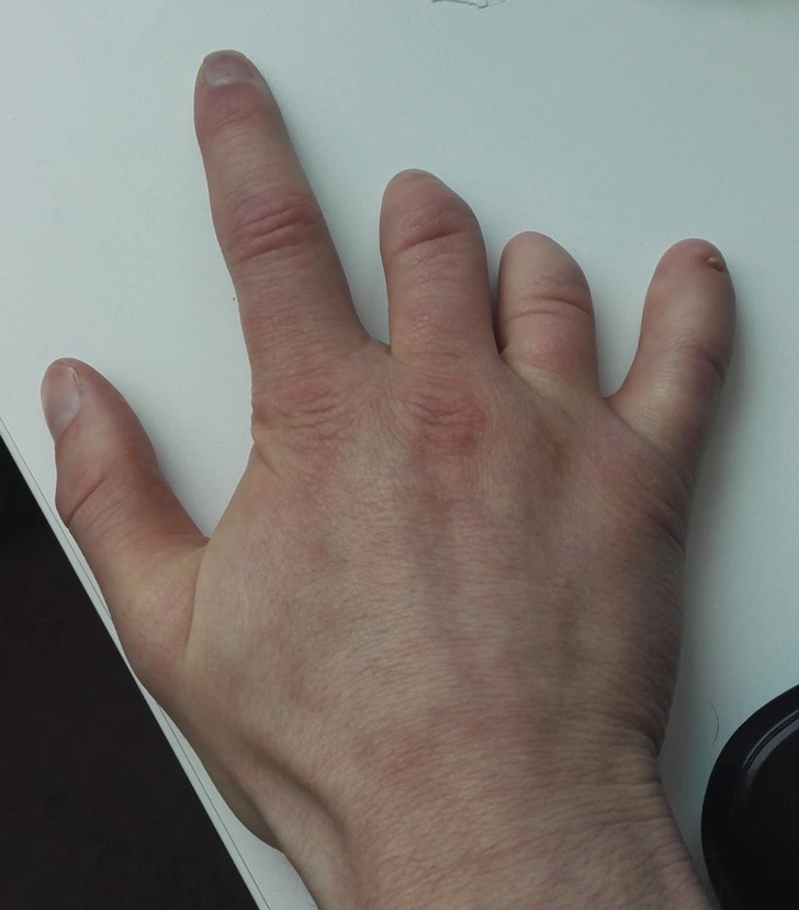 body traits - Abnormally Short Fingers