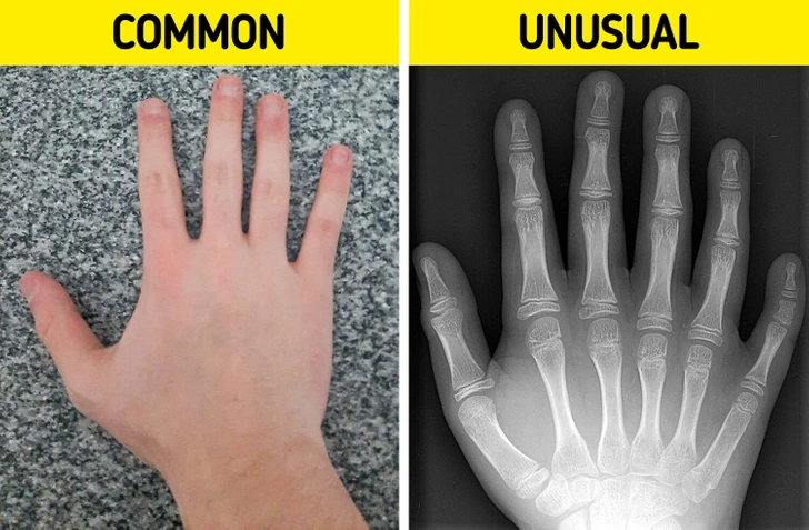 Certain individuals possess more than the typical five fingers or toes on each hand or foot, a condition known as polydactyly