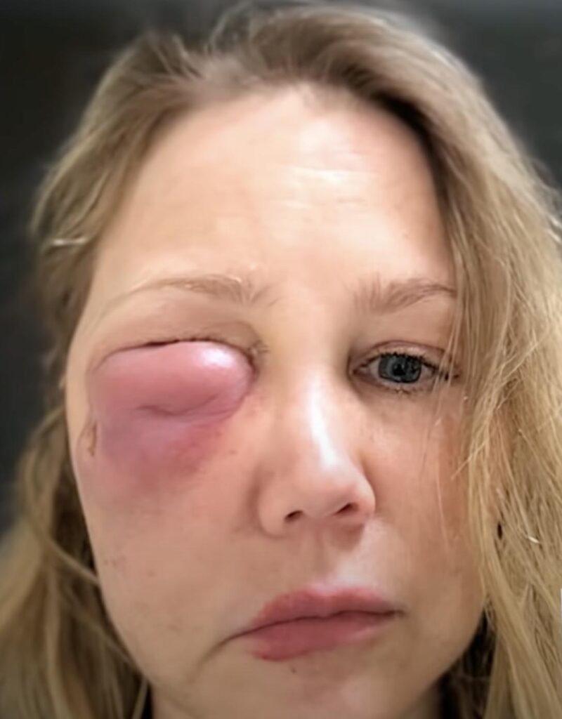 Woman with swollen eye