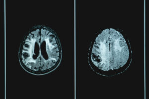 Woman Living With Dementia for 10 Years Tried One Fix That Changed Everything Vacular,Dementia,Mri,Brain