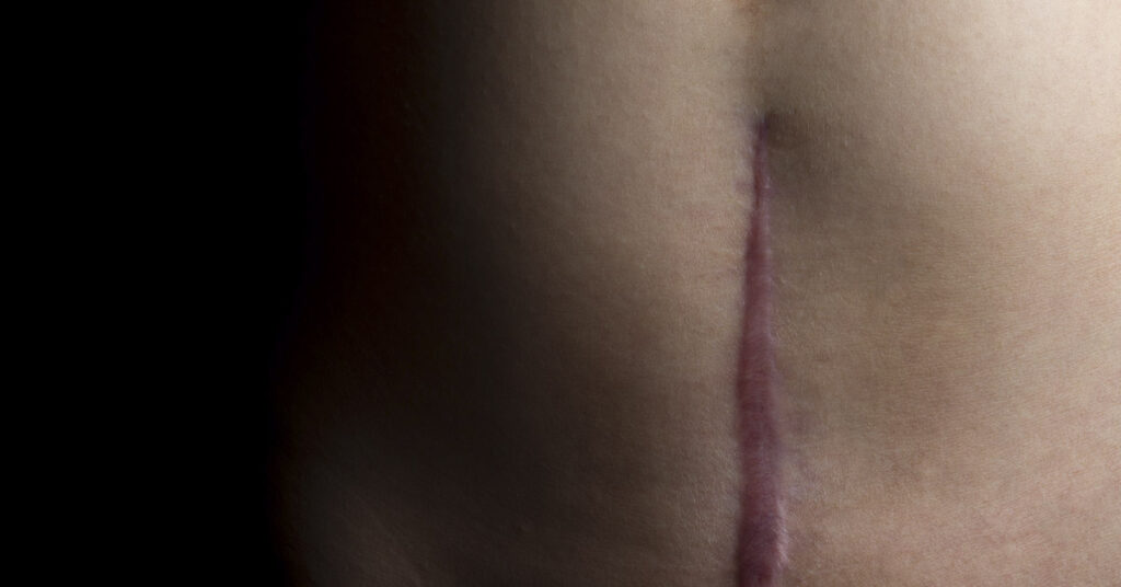 A Woman’s Unbelievable Act of Survival: She Performed Her Own C-Section - Featured image