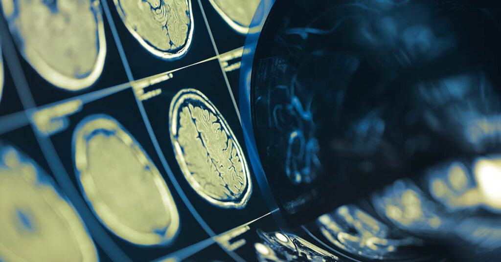 14 Conditions That Drastically Change Your Brain - Featured image